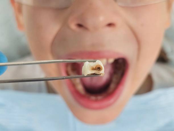 Best Emergency Broken Tooth Repair in Atascocita, TX